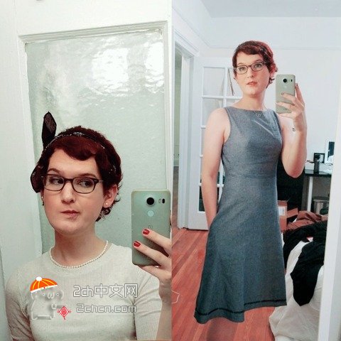 秃头大叔服用雌性激素,秃头男吃雌激素一年