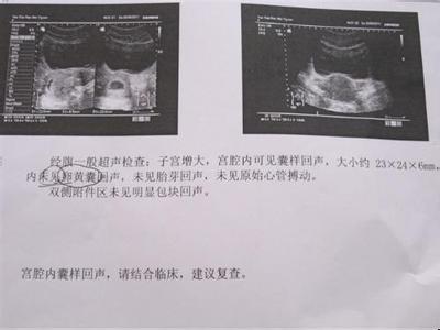 宫外孕有哪些症状?异位妊娠要注意,否则一身麻烦
