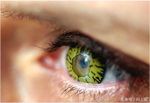佩戴隐形眼镜注意事项,隐形眼镜佩戴注意细节