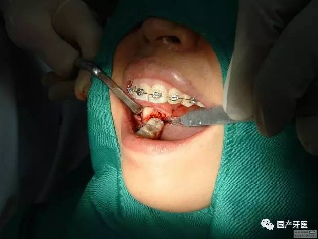 拔智齿瘦了20斤,拔完智齿变成了瓜子脸