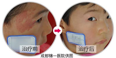 鲜红斑痣到底需不需要治疗？这个难题有答案了