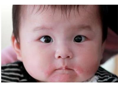 纠缠不清”的湿疹，拿你怎么办