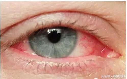 新冠红眼病有什么症状,羔羊红眼病的症状及治疗