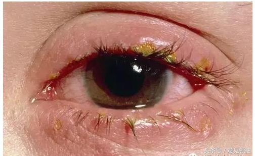 新冠红眼病有什么症状,羔羊红眼病的症状及治疗