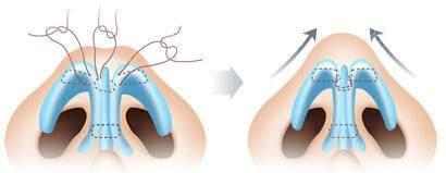 怎么按摩可缩小鼻头,鼻头肥大怎么按摩变小