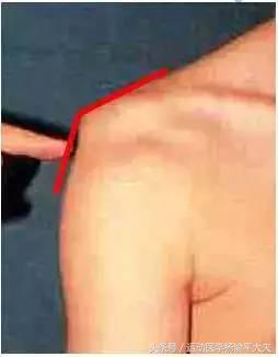 大夫把患者胳膊掰断了怎么赔,医生胳膊酸怎么办