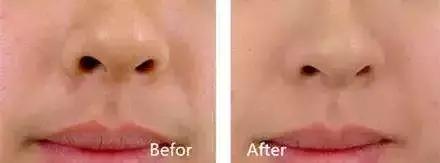 我们有没有为脱毛烦恼过,为了减肥都做过什么事