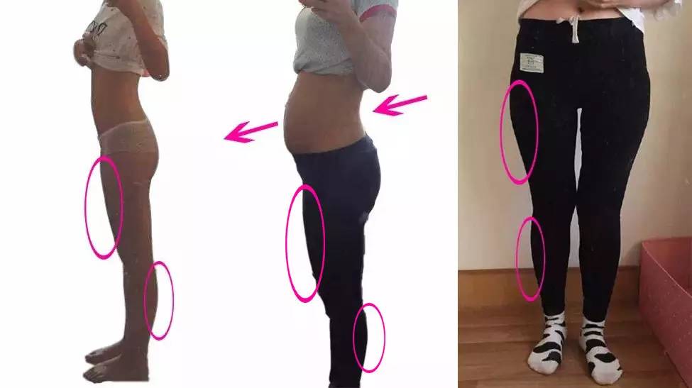 为啥有些女生很瘦却腿粗,为什么女生很瘦但腿很粗