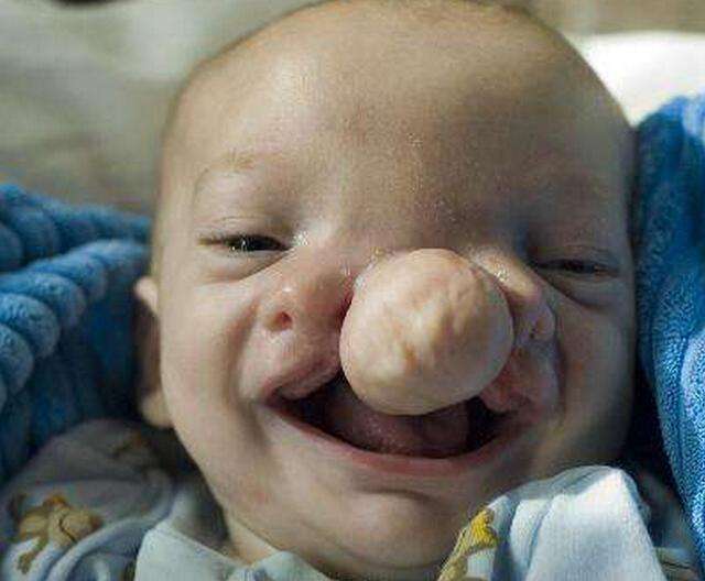 一个小孩一出生就长着猪鼻子,刚出生的婴儿猪鼻子