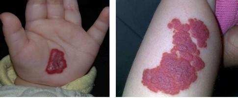 草莓状血管瘤打一次针多少钱,草莓状血管瘤治疗可以报销吗