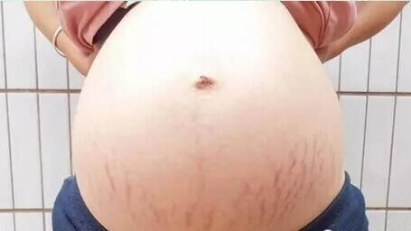 你比我更懂的妊娠纹的痛