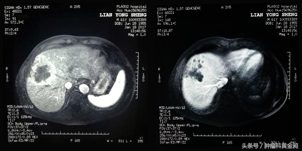 介入栓塞治疗和化疗哪个效果好,肺癌介入栓塞化疗对人的危害