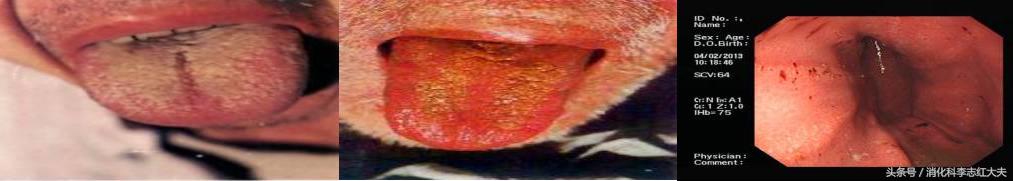 反流食管炎加萎缩性胃炎中医治疗,反流性食管炎中医把脉能看出来吗