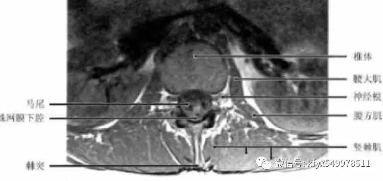 教你如何看腰椎磁共振