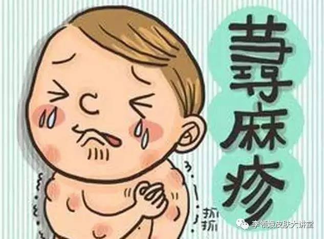 麻疹反复发作是怎么回事,麻疹持续瘙痒几天