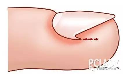 大脚趾甲有点轻微的嵌甲怎么处理,嵌甲手术后指甲还能恢复原样吗
