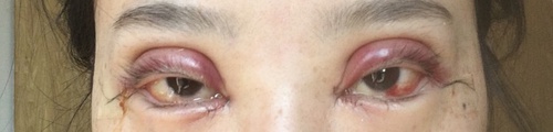 全切双眼皮疤痕增生多久可以恢复,全切双眼皮恢复过程经历真实