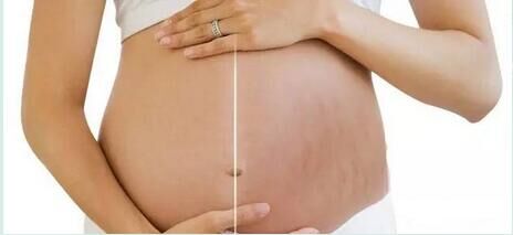 你比我更懂的妊娠纹的痛