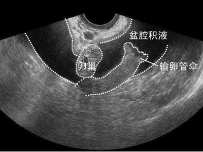 看到盆腔积液先别怕，可能并没有什么事！