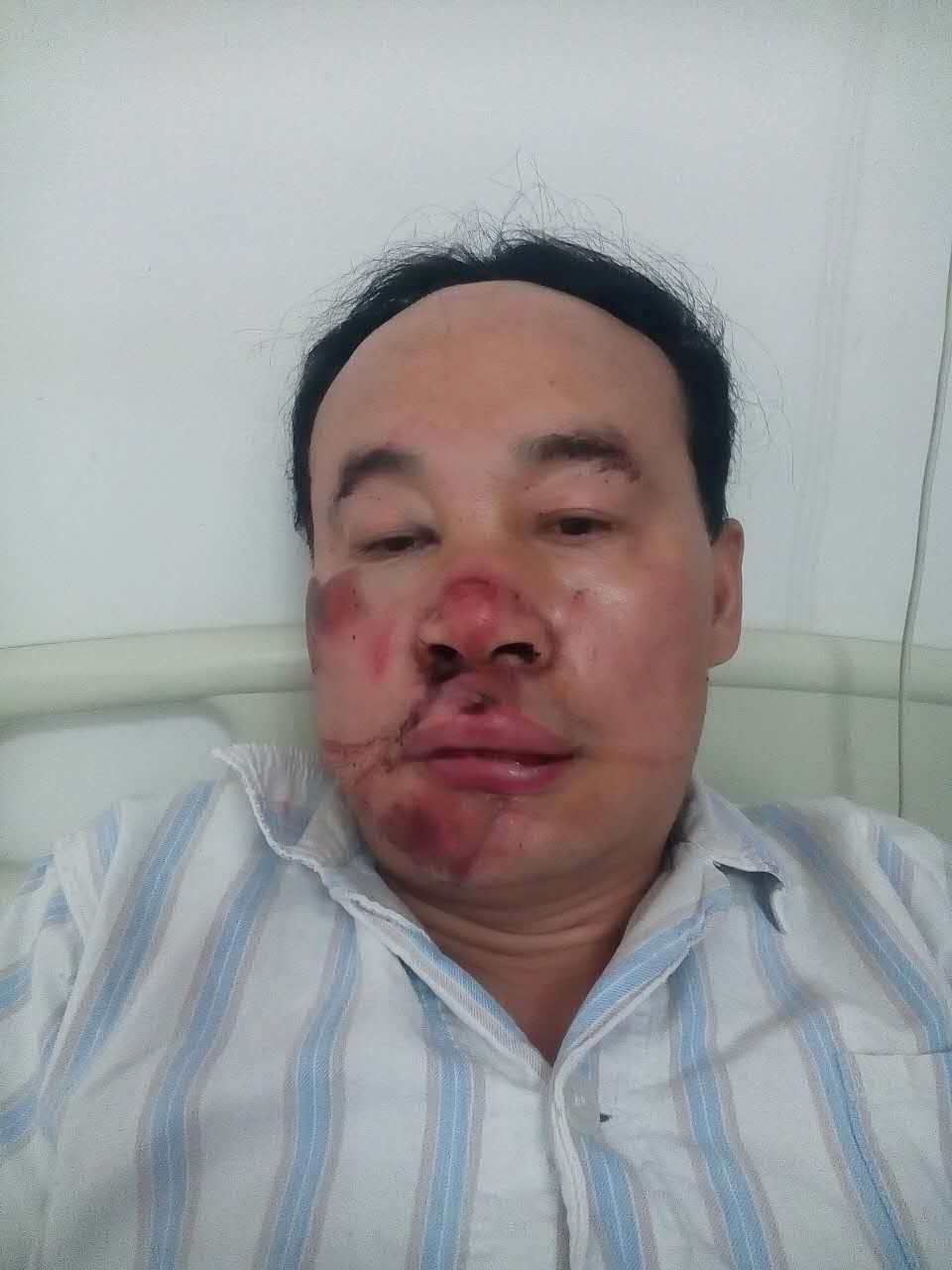 唐山老大哥骑车栽进无盖井，磕掉四颗门牙