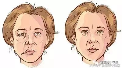 面瘫易发季节怎么防治,面瘫的高发季节