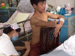 抽脂后胖了凹凸不平,严重抽脂减肥后图片