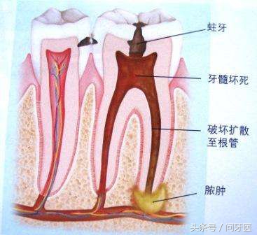 牙齿上药杀神经全过程,儿童牙齿杀神经的步骤