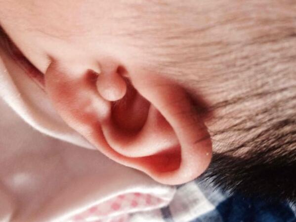 小孩耳边长个肉疙瘩是什么,宝宝耳边长了点凸起的肉