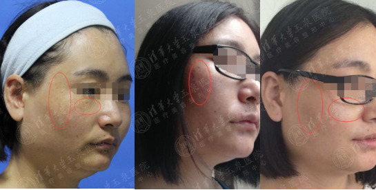 激光祛斑反弹最真实的经历,都说激光祛痘没用是真的吗