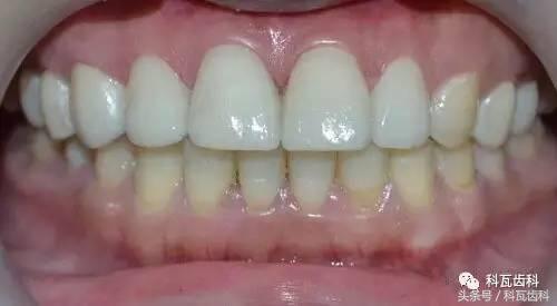 门下门牙有缝隙怎么补救,门牙开缝怎么处理最好