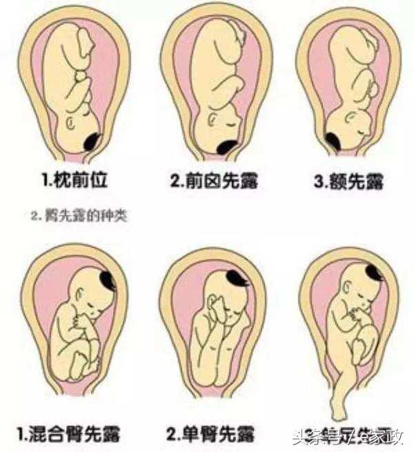 分娩时最常见的胎方位,临产时正确的胎位是怎样的