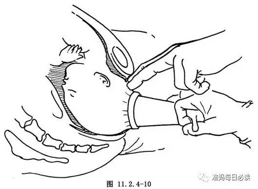 助产动作孕晚期,助产方式有哪些