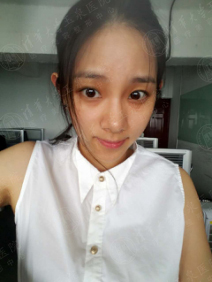 打了水光针,打了一年的水光针