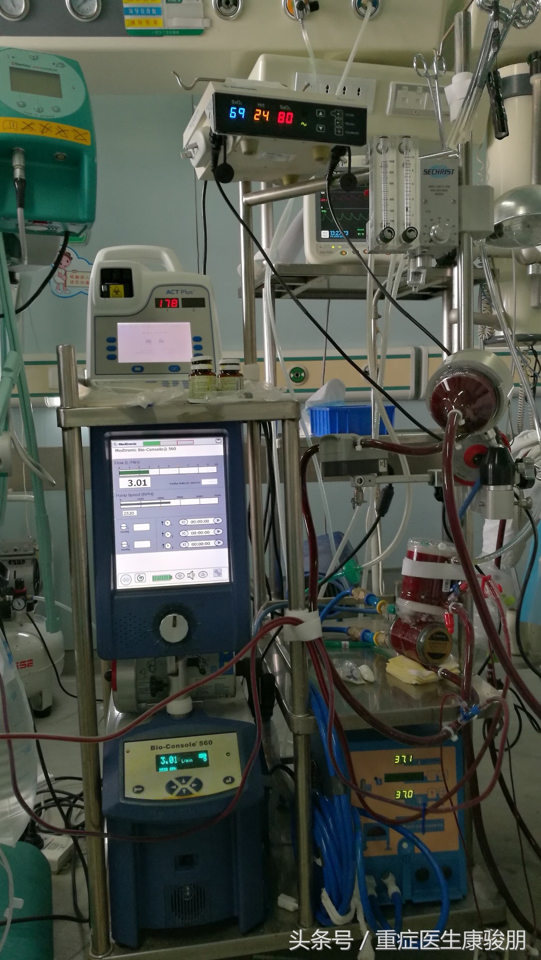 ecmo相当于哪种急救方法,ecmo到第几天开始出现并发症