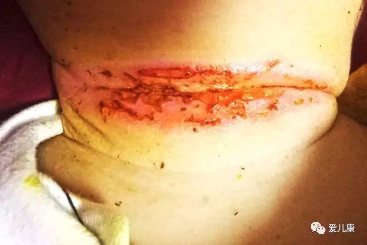 宝妈们孩子脖子淹了用什么好得快,宝宝脖子淹了土方法