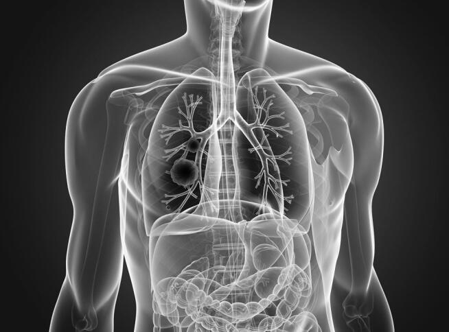 老人长期卧床吸入性肺炎会死吗,老人防止肺炎