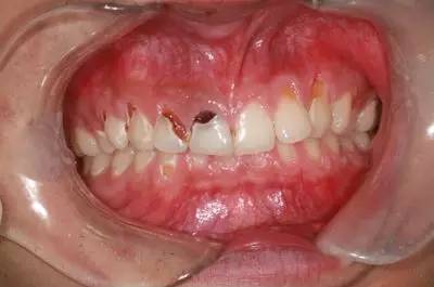 可乐牙治疗实拍,可乐牙治疗好前后图片