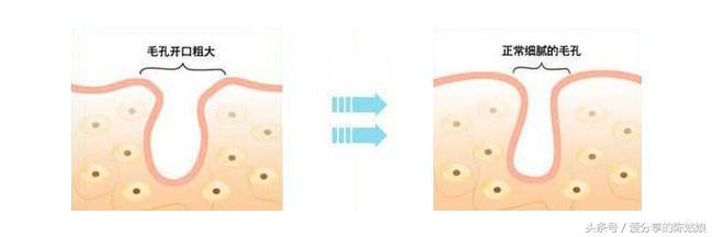 烫伤后毛孔变大会恢复正常吗,毛孔变大了还有没有办法修复