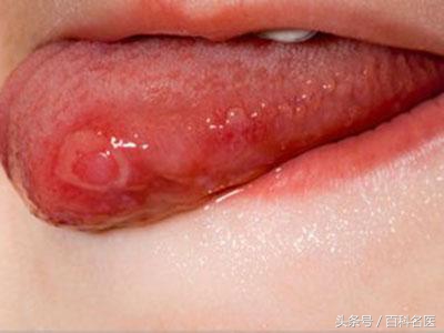 哪些病会引起口腔溃疡,什么样的口腔溃疡要警惕