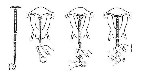 节育环取出注意些什么,女性节育环取环前注意事项