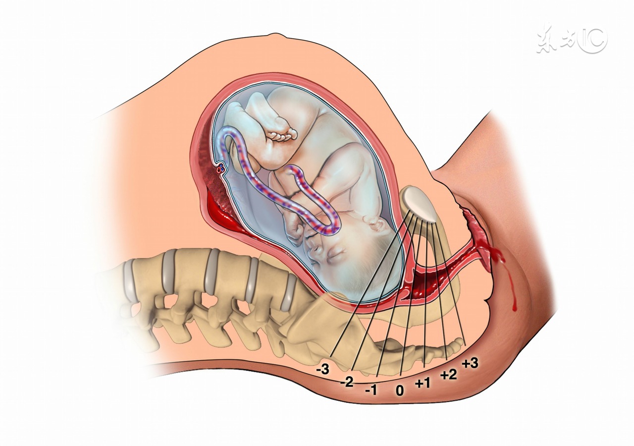 顺产产后伤口护理操作,顺产产后切口护理