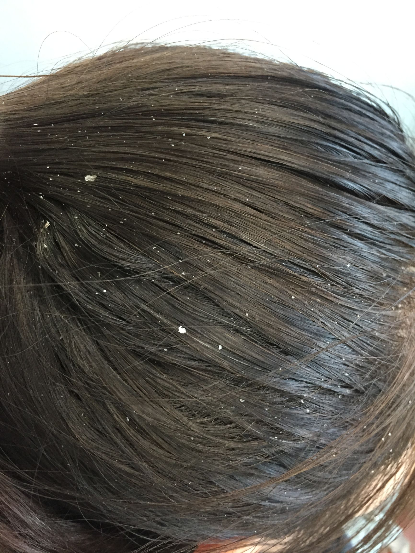 头皮屑痒用什么药最好,头皮屑多头皮痒用什么药最好