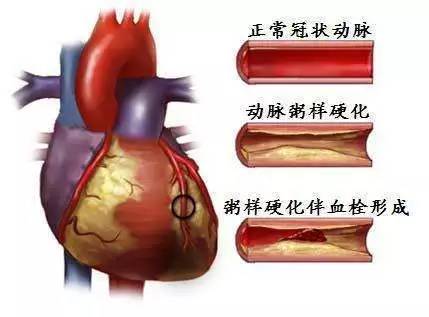 揭秘心绞痛症状,心绞痛的症状及自查六大细节
