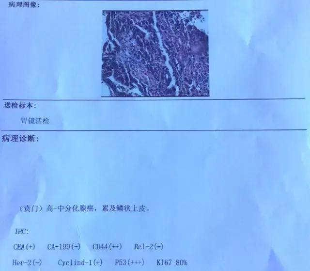 胃底贲门中分化腺癌怎么来根治,胃底贲门低中分化腺癌能治愈吗