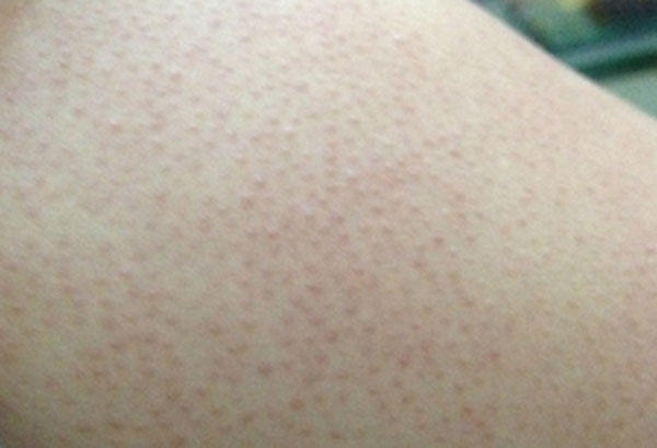 去腿上鸡皮疙瘩的小妙招,快速消除鸡皮疙瘩的小妙招