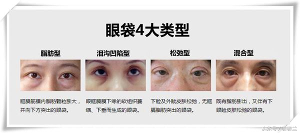 眼袋一笑就成卧蚕了是啥类型眼袋,什么样的眼袋是真正的眼袋