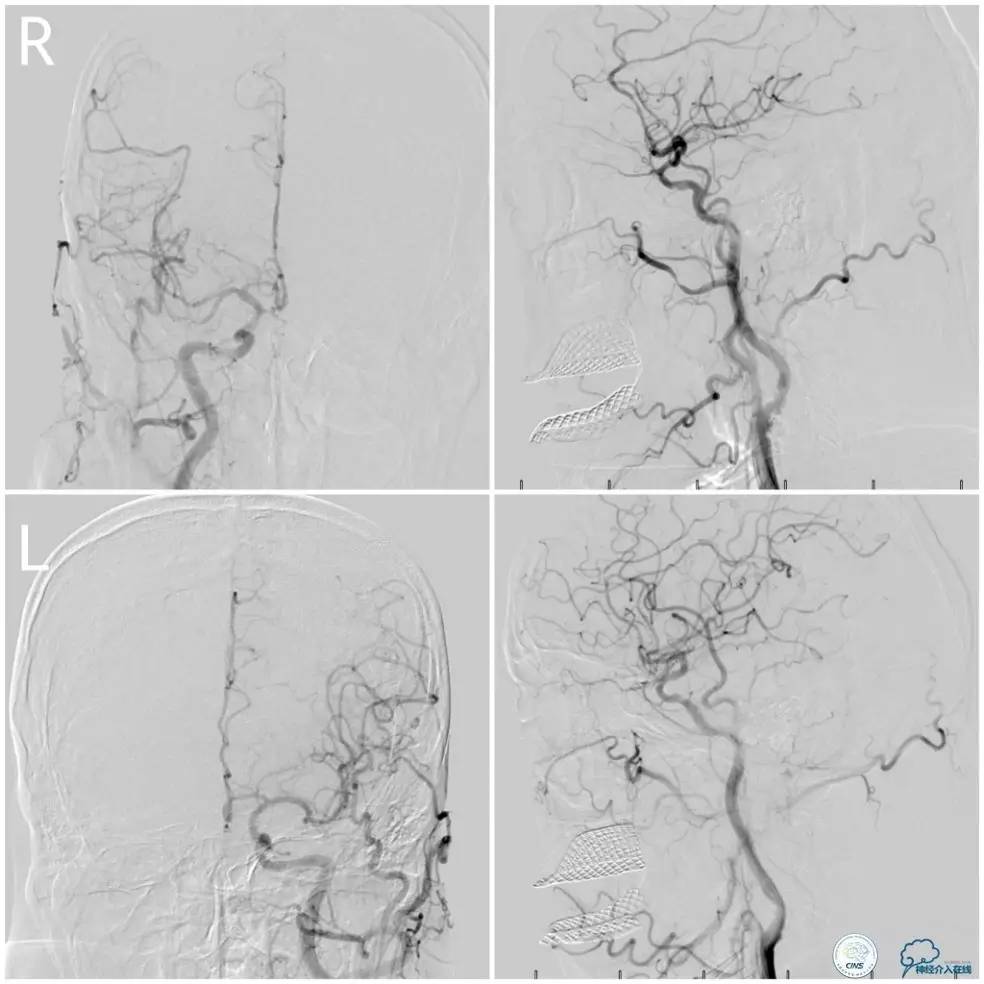 天坛周记|右椎动脉V1段及V4-基底动脉串联病变支架治疗一例
