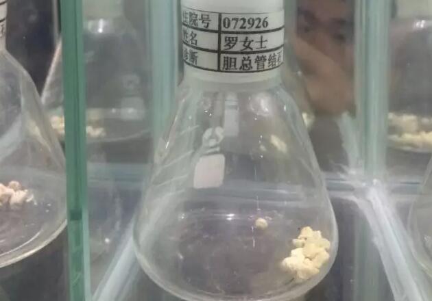 一医院设立胆结石博物馆,胆结石博物馆