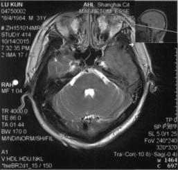 颅内静脉窦血栓怎么治疗,颅内静脉窦血栓造影多少钱