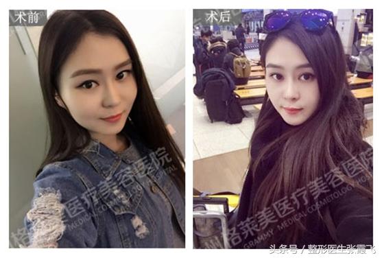 瘦脸针能瘦脸这种说法正确吗,瘦脸针真的能起到瘦脸的效果吗